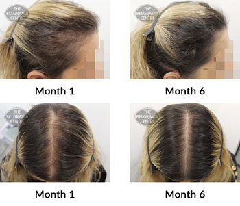 alert female pattern hair loss and diffuse thinning the belgravia centre 262034 22 11 2019