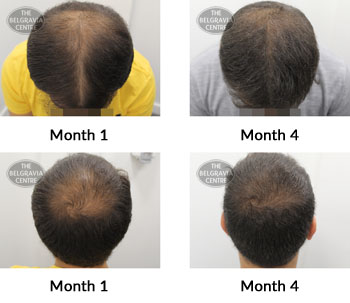 alert male pattern hair loss the belgravia centre 387269 12 11 2019