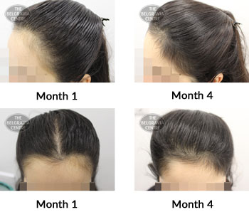 alert female pattern hair loss the belgravia centre 387146 12 11 2019