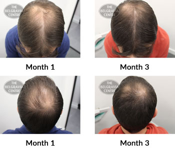 alert male pattern hair loss the belgravia centre 386086 12 11 2019