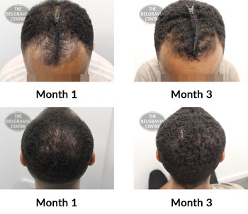 alert male pattern hair loss the belgravia centre 385095 04 11 2019