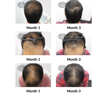 alert male pattern hair loss the belgravia centre 386042 04 11 2019