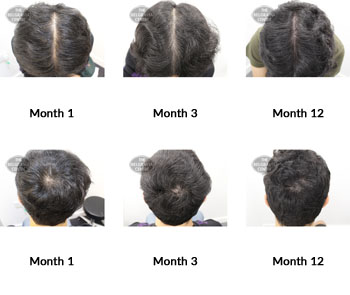 alert male pattern hair loss the belgravia centre 369490 30 10 2019