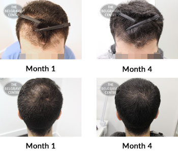 alert male pattern hair loss the belgravia centre 386294 25 10 2019