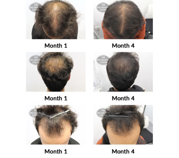 alert male pattern hair loss the belgravia centre 385515 22 10 2019