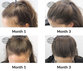 alert female pattern hair loss the belgravia centre 386648 17 10 2019