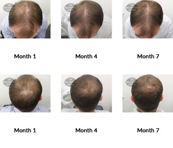 alert male pattern hair loss the belgravia centre 379039 16 10 2019