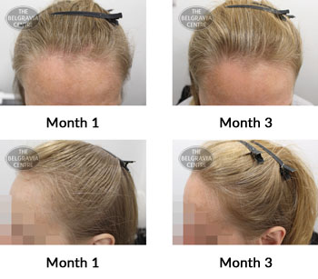 alert diffuse thinning and female pattern hair loss the belgravia centre 390216 14 10 2019