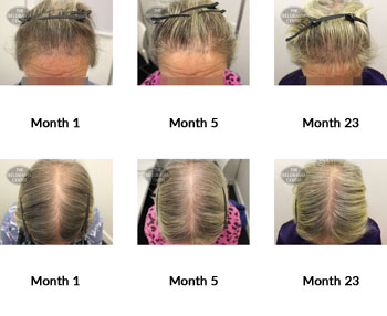 alert diffuse thinning and female pattern hair loss the belgravia centre 261530 08 10 2019