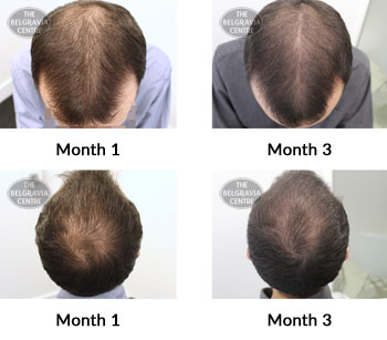 alert male pattern hair loss the belgravia centre 382035 03 10 2019