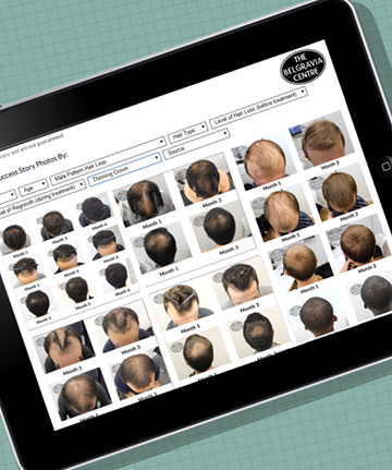 Belgravia Centre Male Pattern Hair Loss Treatment hair regrowth Success Stories Thinning Crown