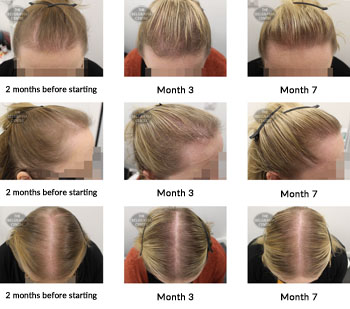 alert female pattern hair loss the belgravia centre 377349 07 10 2019
