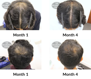 alert male pattern hair loss the belgravia centre 381542 01 10 2019