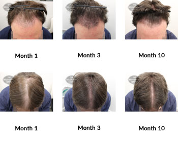 alert male pattern hair loss the belgravia centre 371652 30 09 2019