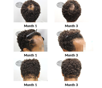 alert male pattern hair loss and trichotillomania the belgravia centre 384417 23 09 2019