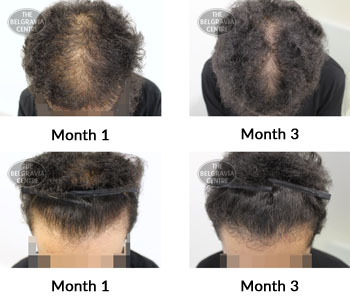 alert male pattern hair loss the belgravia centre 384886 23 09 2019