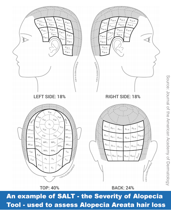 Severity of Alopecia Tool SALT diagram for grading Alopecia Areata Totalis Universalis hair loss