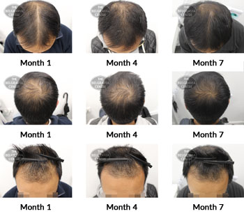 alert male pattern hair loss the belgravia centre 377874 16 09 2019
