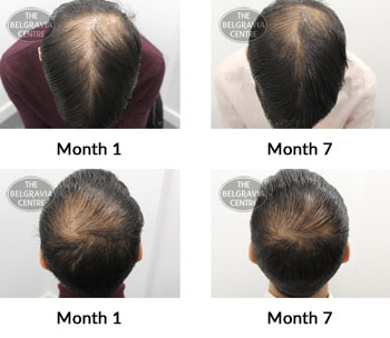 alert male pattern hair loss the belgravia centre 377067 16 09 2019