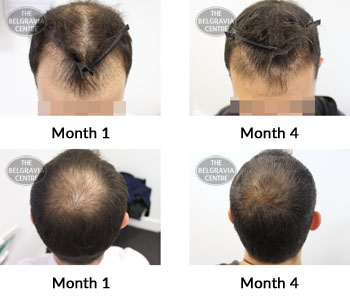 alert male pattern hair loss the belgravia centre 380245 16 08 2019
