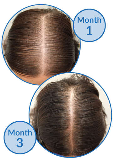 Belgravia Centre Success Story - female pattern hair loss treatment and telogen effluvium hair growth before and after