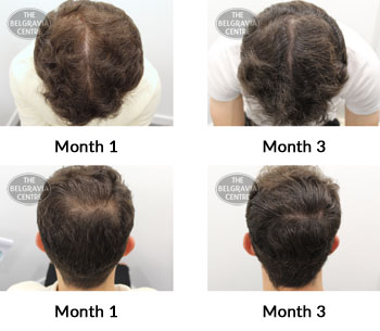 alert male pattern hair loss the belgravia centre 384390 10 09 2019