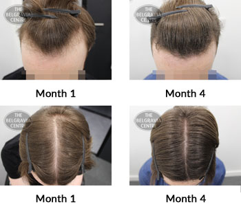 alert male pattern hair loss the belgravia centre 383389 10 09 2019
