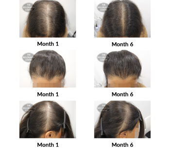alert female pattern hair loss and diffuse hair loss the belgravia centre 379880 03 09 2019