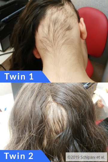 Twins with Alopecia Areata Both Develop Thyroid Problems