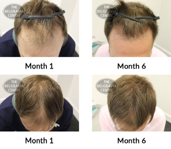 alert male pattern hair loss the belgravia centre 363534 26 08 2019