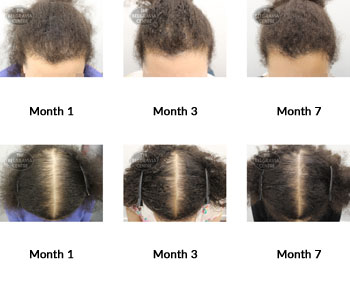alert female pattern hair loss and diffuse hair loss the belgravia centre 378712 23 08 2019