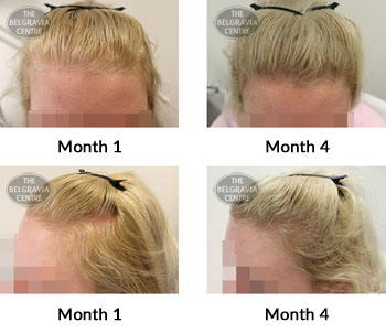 alert female pattern hair loss the belgravia centre 382470 21 08 2019