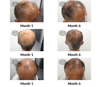 alert male pattern hair loss the belgravia centre 378629 19 08 2019