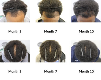 alert male pattern hair loss the belgravia centre 372715 19 08 2019