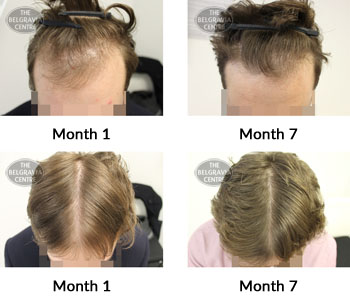 alert male pattern hair loss the belgravia centre 378155 19 08 2019