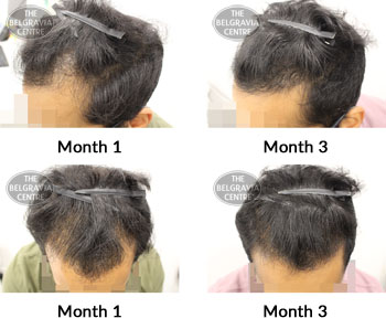 alert male pattern hair loss the belgravia centre 382102 15 08 2019