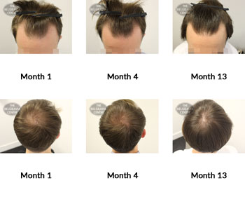 alert male pattern hair loss the belgravia centre 363709 01 08 2019