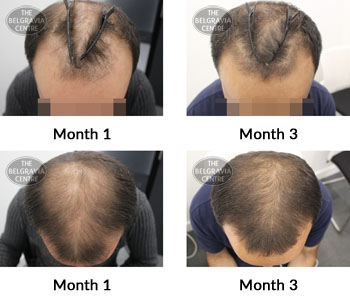 alert male pattern hair loss the belgravia centre 381493 09 08 2019