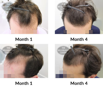 alert male pattern hair loss the belgravia centre 378672 05 08 2019