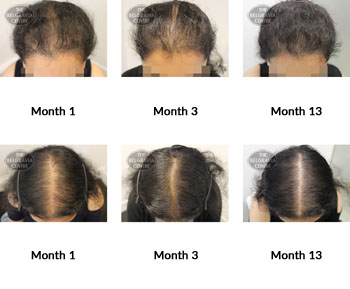 alert female pattern hair loss the belgravia centre 365563 31 07 2019