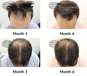 alert male pattern hair loss the belgravia centre 376824 31 07 2019
