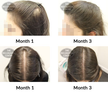 alert female pattern hair loss the belgravia centre 382954 30 07 2019