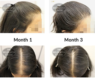 Example of Female Pattern Hair Loss thinning hair before and after women's Hair Loss Treatment Belgravia Centre clinic
