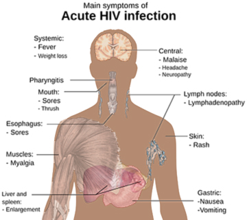symptoms of HIV infection