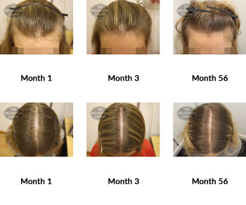 alert diffuse hair loss and female pattern hair loss the belgravia centre 118325 22 07 2019