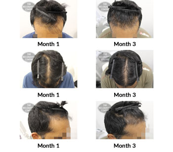 alert male pattern hair loss the belgravia centre 346688 22 07 2019