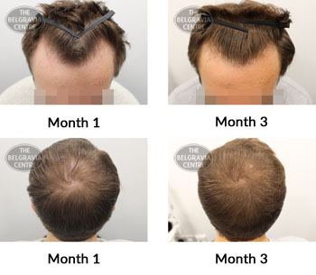 alert male pattern hair loss the belgravia centre 379881 17 07 2019