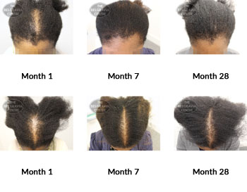 alert female pattern hair loss and traction alopecia the belgravia centre 330161 24 06 2019 1