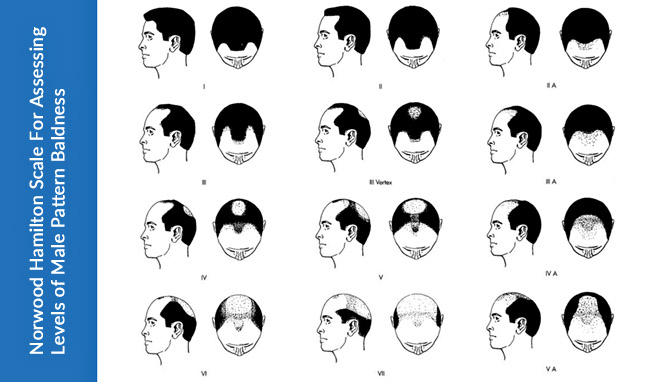 Norwood Scale for Assessing Levels of Hair Loss Baldness in Men