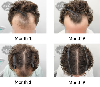 alert male pattern hair loss the belgravia centre 369815 15 07 2019